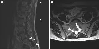 multiple tarlov cysts